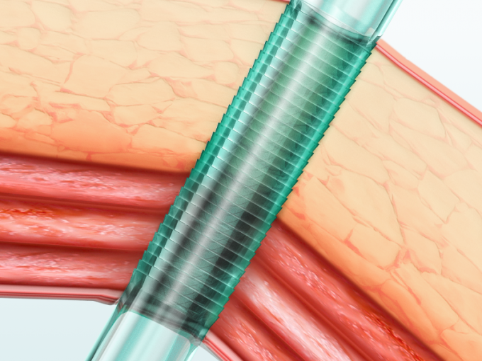 Laparoscopic Instrumente Wegwerf-Trocar-Cannula mit Blatt 0