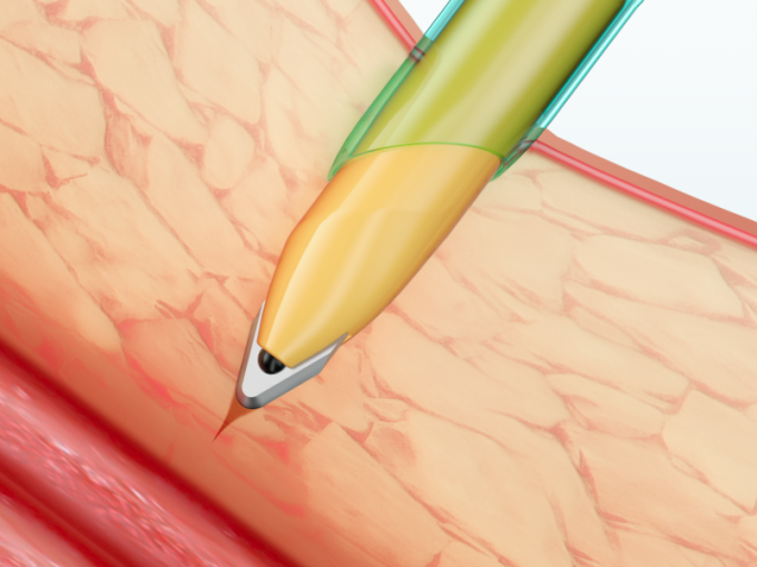 Laparoscopic Instrumente Wegwerf-Trocar-Cannula mit Blatt 1