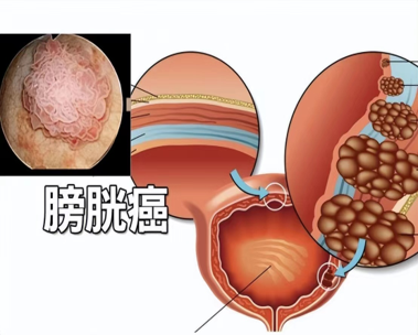 neueste Unternehmensnachrichten über Klinische Diagnose und physiologische Behandlung von Blasenkrebs. 0